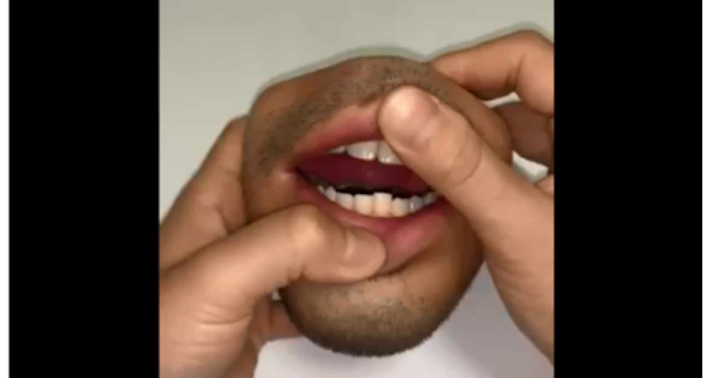 Tooth, Cheek, Chin, Lips, Jaw, Eyebrow, Mouth, Tongue, Forehead, Thumb, lip, Tooth, Nose, Mouth, Facial expression, Close-up, Tongue, Skin, Lip, Organ, Jaw